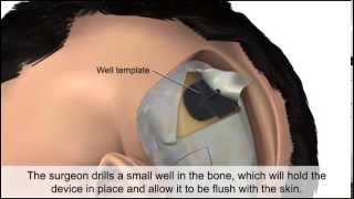 Cochlear Implant [upl. by Sldney]