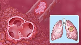 Understanding NonSmall Cell Lung Cancer [upl. by Vivyan]