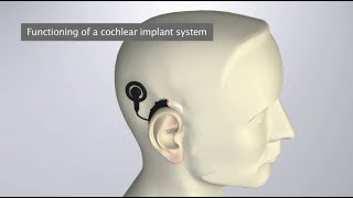 How Do Cochlear Implants Work The SYNCHRONY Cochlear Implant  MEDEL [upl. by Roosnam680]