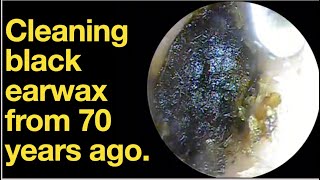 Cleaning black earwax from 70 years agoear wax removal  ear cleaning  ASMR  relaxation  relax [upl. by Nayarb432]